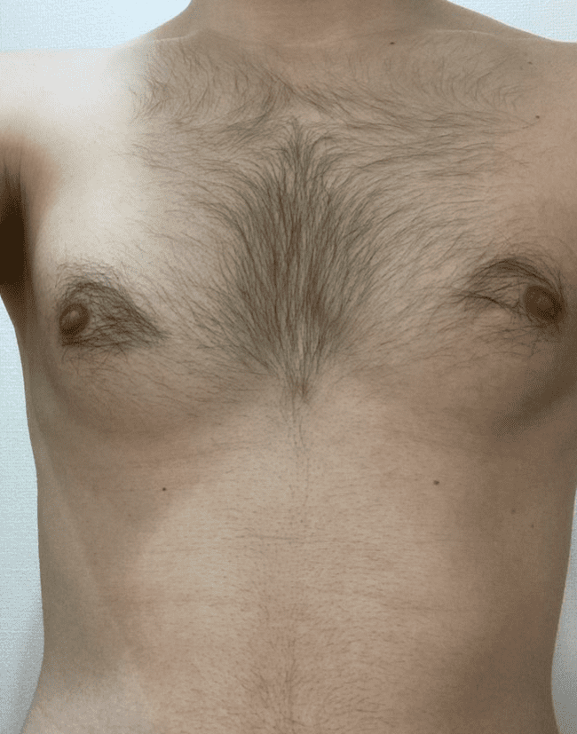 除毛前の胸毛と腹毛1
